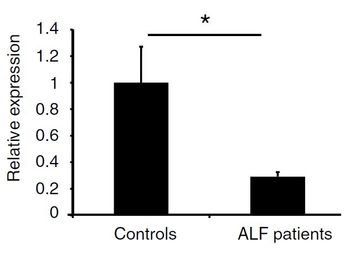 MicroRNA-125b-5p – a new treatment option for drug induced Acute Liver Failure