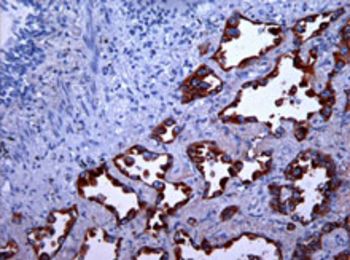 MAdL monoclonal antibody: A novel, highly specific and sensitive biomarker for adenocarcinomas of the lung