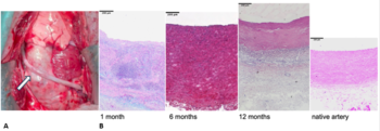Bioartificial vascular grafts based on a highly compacted acellular fibrin matrix