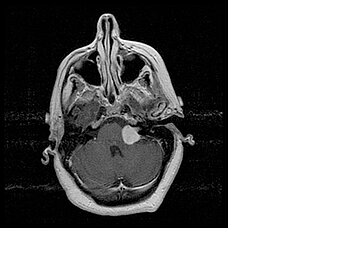 Innovative nerve sheath tumor therapy